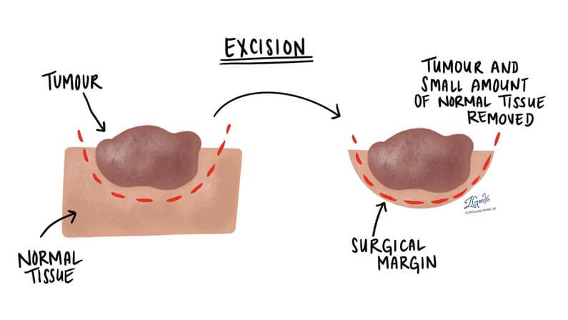 Illustration of excision procedure