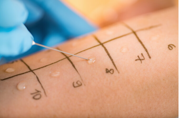 Close up photo of skin allergy test