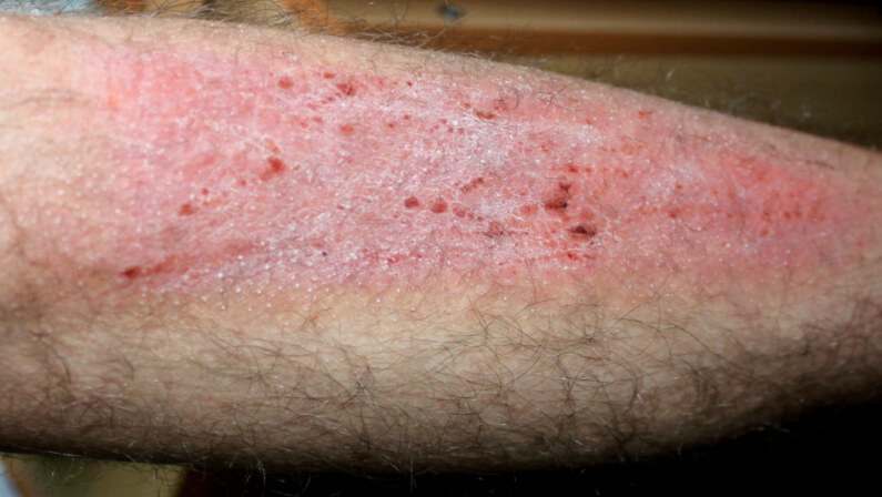 Lichen Simplex Chronicus on legs