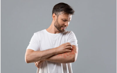 How To Deal With Psoriasis Flare-Up