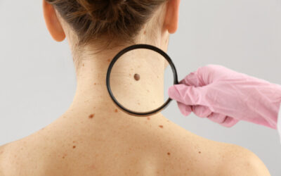 How Fast Can A Melanoma Grow?