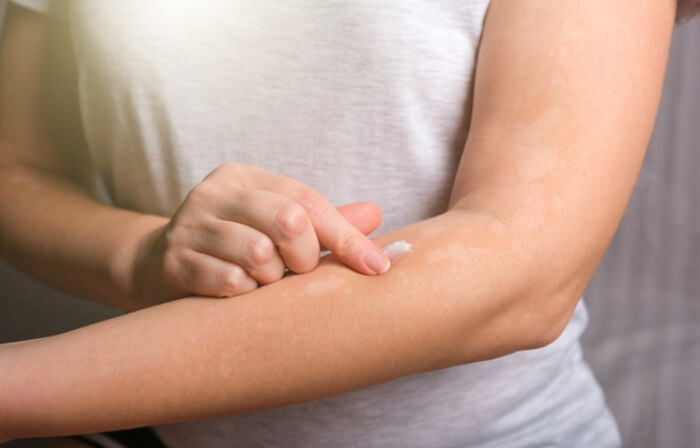 Female applying cream to her arm treating her Neurodermatitis