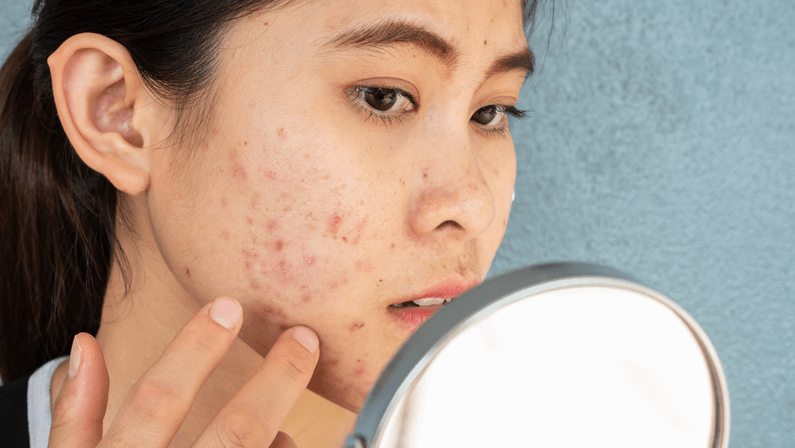 Woman checking her face with acne breakout in a mirror 