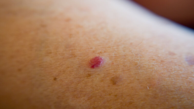 Cherry angioma on skin