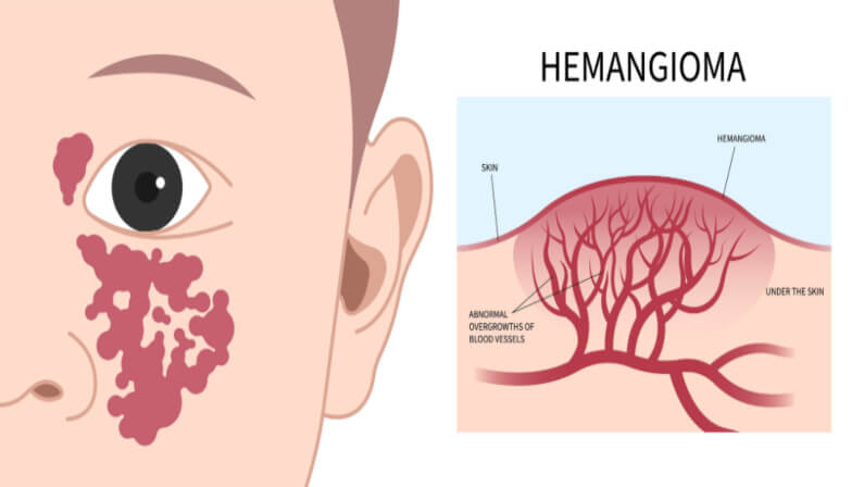 Illustration of cherry hemangiomas