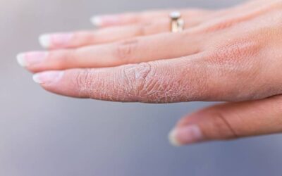 How To Treat Dry And Cracked Hands