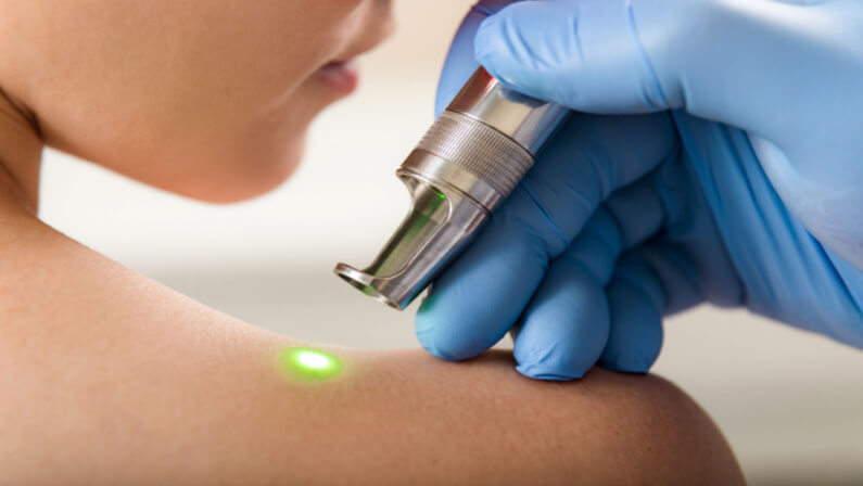 Cherry angiomas removal through laser surgery