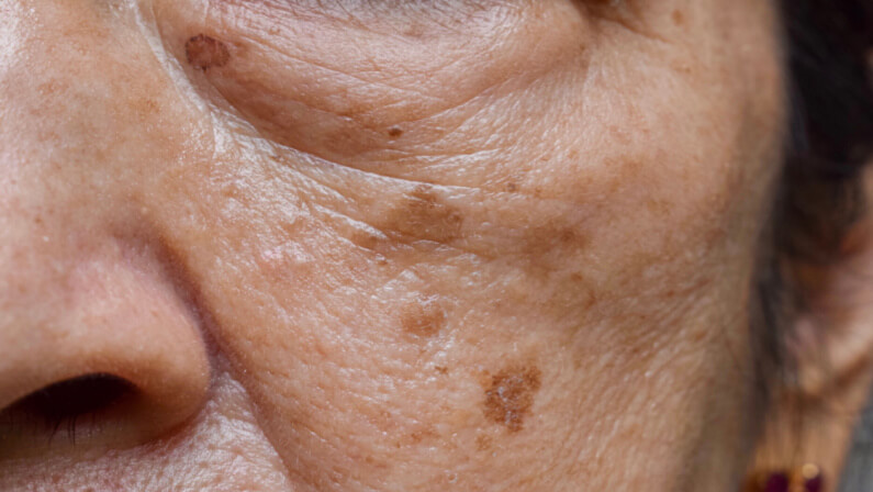 Old age dark spots on a woman's face