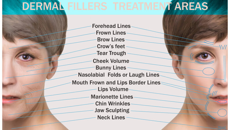 Parts of the face that can be treated with fillers