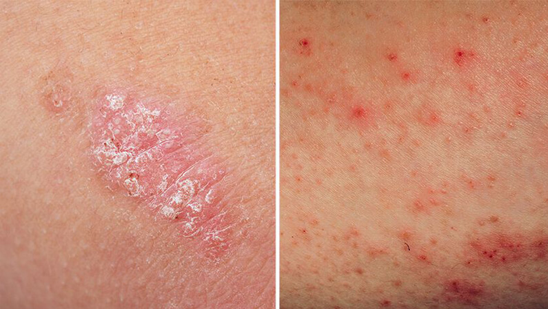 Hvad angår folk Almindeligt trone Difference Between Eczema and Psoriasis | Skin Cancer Specialists