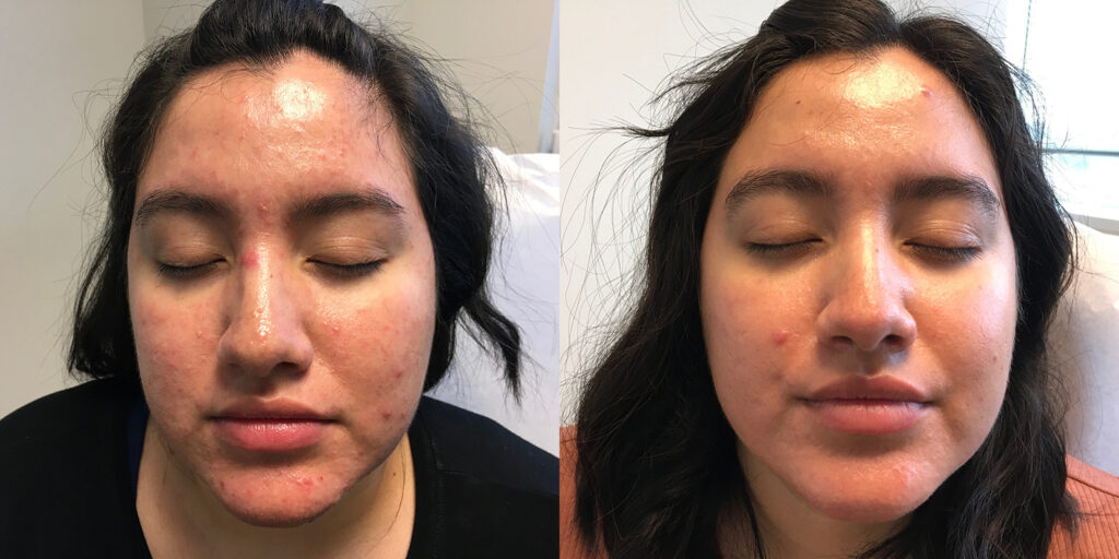 Acne Treatments Before and After Photo by Skin Cancer Specialists in Sugar Land Texas