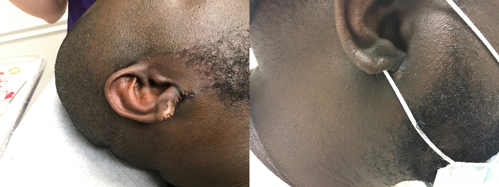 Keloid Excision Before and After Photo by Skin Cancer Specialists in Sugar Land Texas