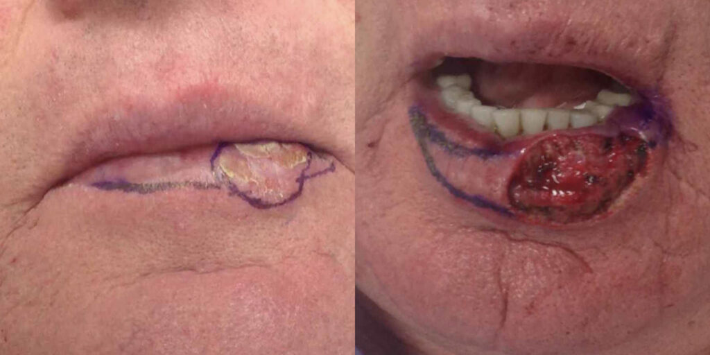 Mohs Surgery Before and After Photo by Skin Cancer Specialists in Sugar Land Texas