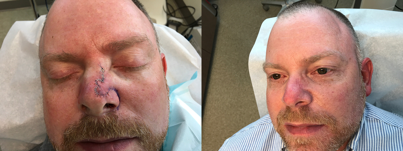 Mohs Surgery Before and After Photo by Skin Cancer Specialists in Sugar Land Texas