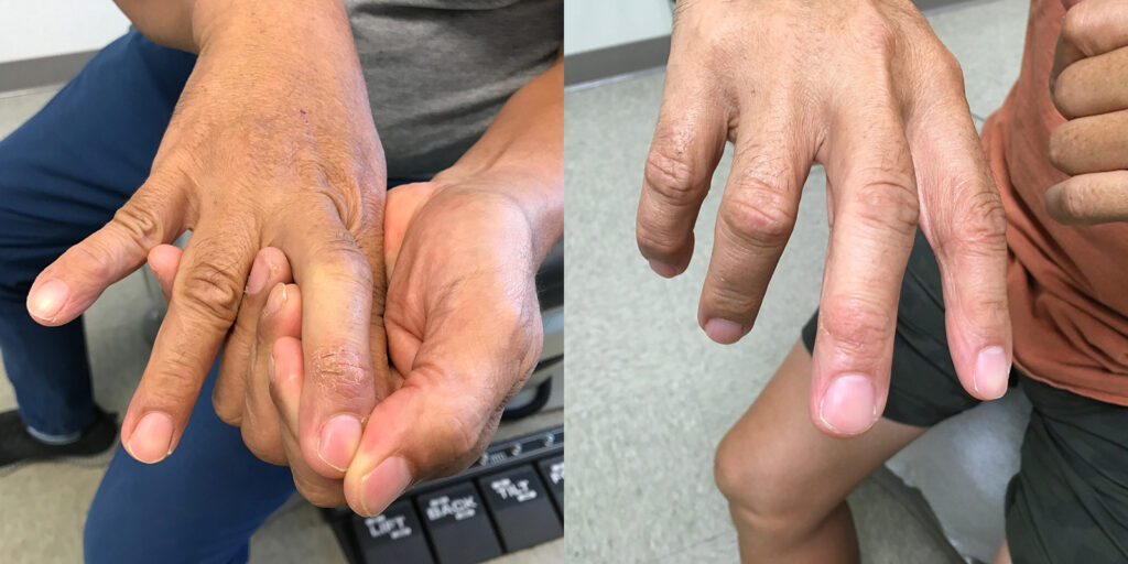 Rash Treatments Before and After Photo by Skin Cancer Specialists in Sugar Land Texas