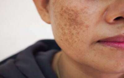 woman with dark spot on face x